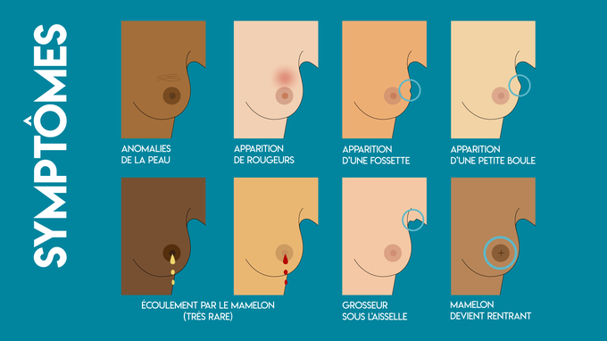 different cancer du sein different cancer du sein